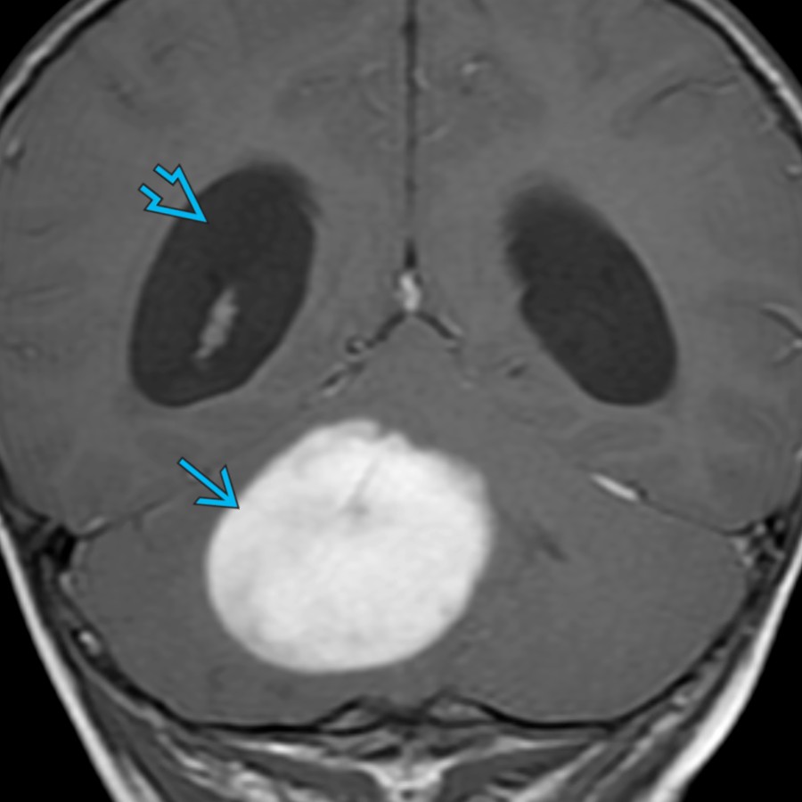 Coronal T1 C+ MR in a 2-year-old with a uniformly enhancing mass  centered in the right cerebellar hemisphere is shown. Note the associated hydrocephalus . While the cerebellum is the most common location for PAs, it is an uncommon location for PMAs.