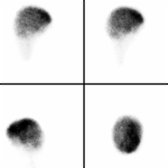 48-hour multiplanar images in the same patient show homogeneous distribution of tracer over brain.