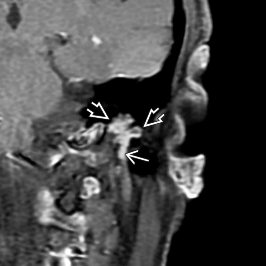 Coronal T1 C+ FS MR in a patient with conductive hearing loss and facial twitching shows a multilobular, enhancing FNS  that has broken into mastoid air cells and projects inferiorly along the mastoid CN segment .