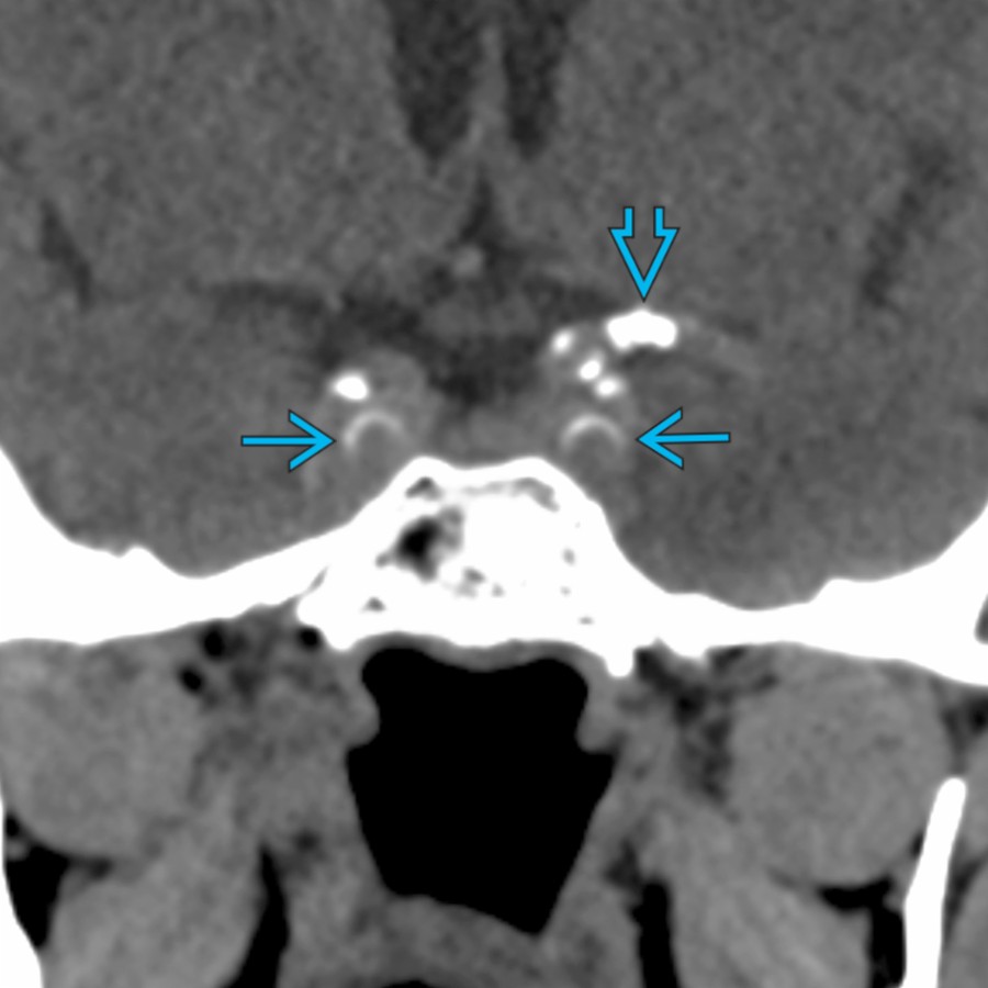 Coronal NECT shows atherosclerotic calcifications along the walls of the bilateral intracranial ICAs  and left MCA . Intracranial atherosclerosis often involves the intracranial internal carotid and vertebral arteries. There is often mural calcification and decreased vessel caliber.