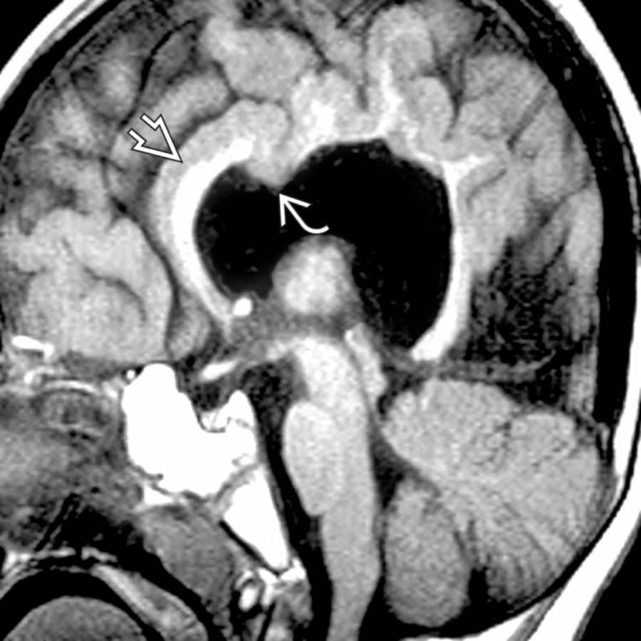Midline sagittal T1 MR shows both white & gray matter  crossing midline anterior & posterior to the "dip"  in the corpus callosum, where only gray matter traverses. This is a middle interhemispheric variant of holoprosencephaly (syntelencephaly).