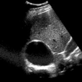 Sagittal US shows a sonolucent mass above the right kidney that proved to be an adrenal cyst.