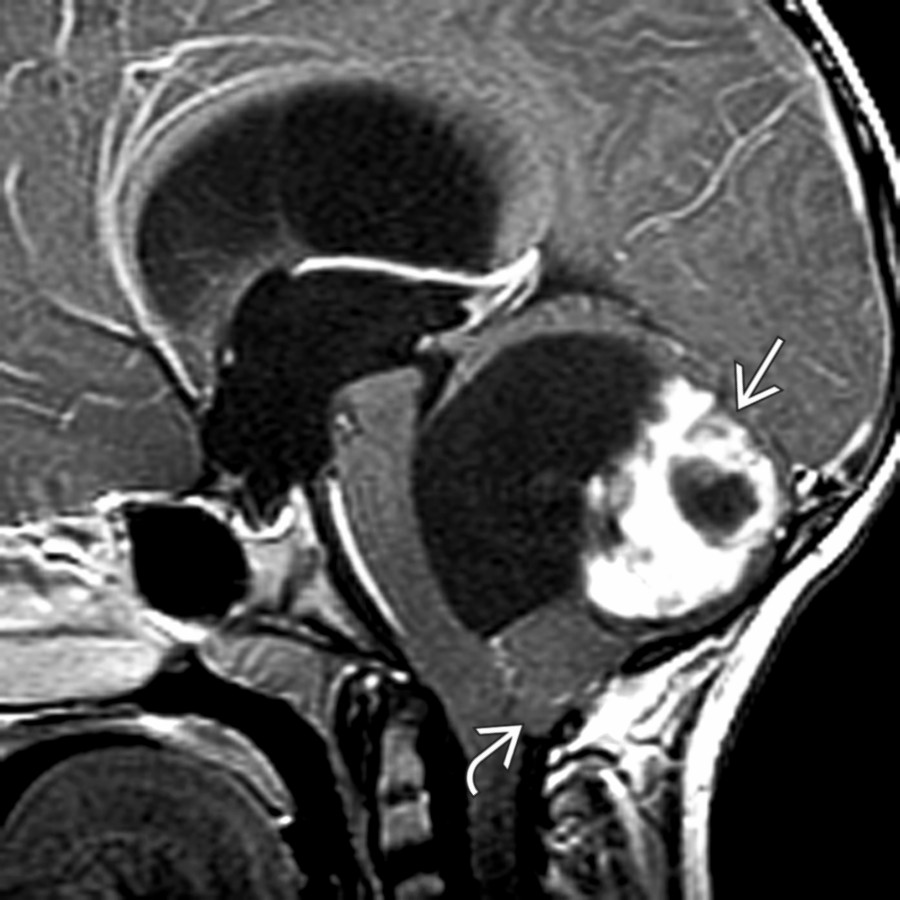Sagittal T1 C+ MR shows a typical tumor cyst with an enhancing mural nodule . There is hydrocephalus and protrusion of the cerebellar tonsils  through the foramen magnum (acquired Chiari type 1).