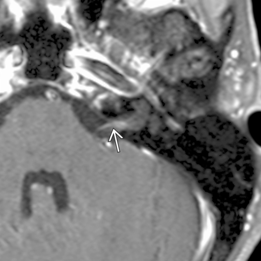 Axial T1 C+ FS MR shows vestibulocochlear neuritis in a patient with rapid onset of sensorineural hearing loss. Note the area of linear enhancement in the proximal IAC .