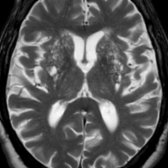 Axial T2 MR in 82-year-old man demonstrates enlarged perivascular spaces  in the basal ganglia bilaterally giving a cribriform appearance. With advancing age, perivascular spaces are found with increasing frequency & larger apparent size (> 2 mm).
