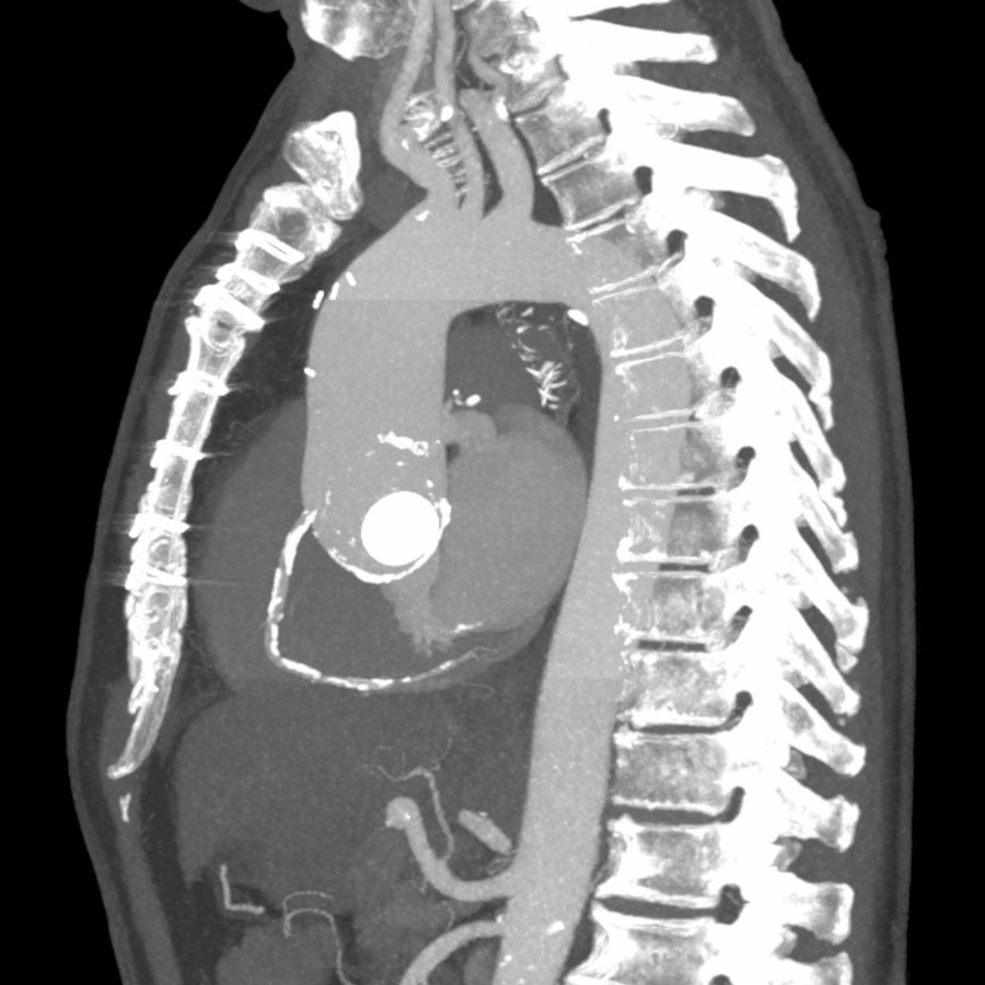 Sagittal CECT MIP shows the contours of the AA in related to the sternum and other mediastinal structures. While the AA is aneurysmal with a maximum transverse diameter of 5 cm, the aortic arch and descending thoracic aorta (DTA) are normal in size.