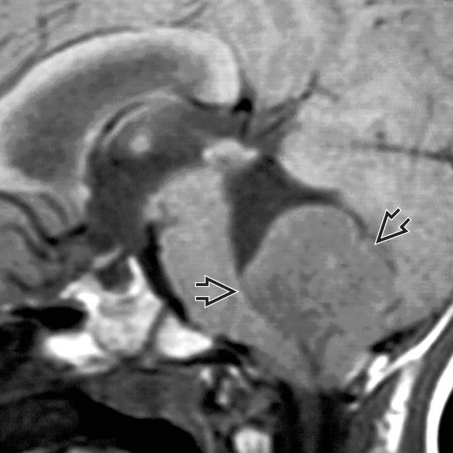 Sagittal T1 MR shows a large mass within the 4th ventricle  causing intraventricular obstructive hydrocephalus or noncommunicating hydrocephalus.