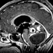 Sagittal T1 C+ FS MR shows a pilocytic astrocytoma involving the cerebellum with heterogeneous enhancement and a large cyst . Note the effacement of the 4th ventricle  rather than expansion, which would be typical for medulloblastoma and ependymomas.