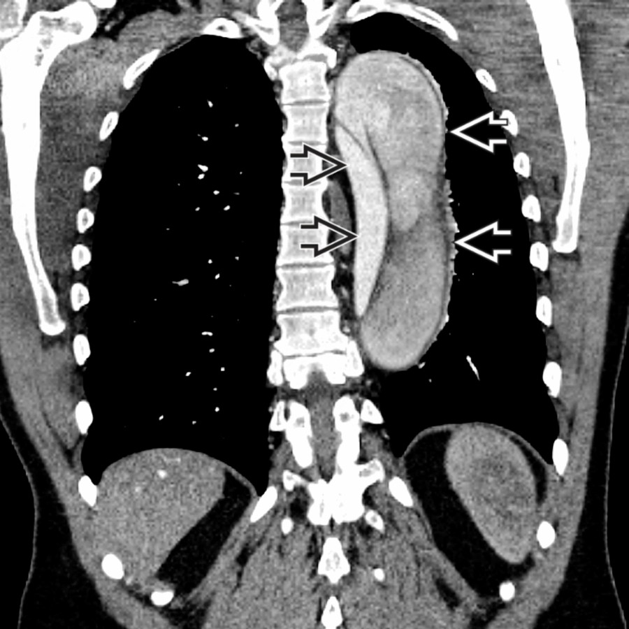 Coronal CTA shows marked compression of the true lumen  by the false lumen . There is partial thrombosis of the false lumen, although still with some enhancement.