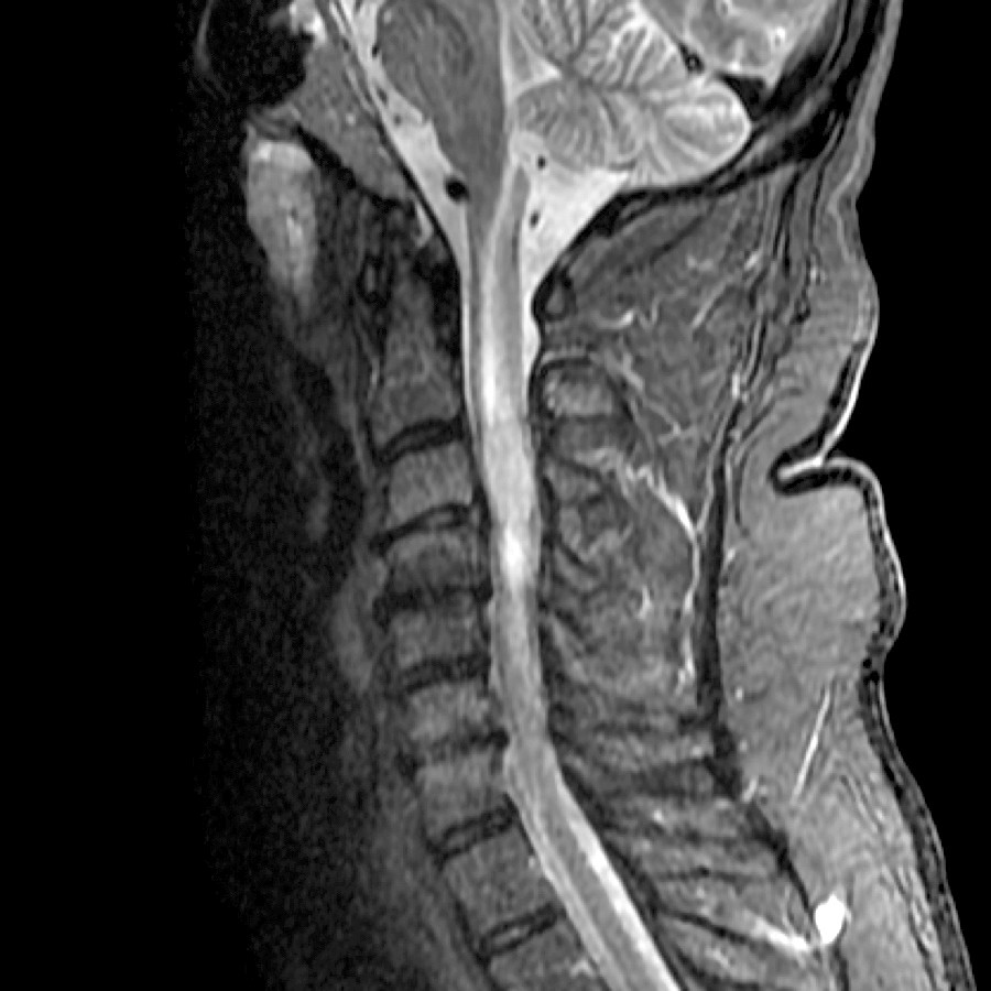 Sagittal T2WI STIR MR shows nonspecific expansion and hyperintensity within the cervical cord in this patient with metastatic disease.