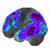 Left lateral F-18 FDG PET quantitative analysis in a patient with advanced AD shows hypometabolism in the parietal   and posterior temporal  lobes. The frontal lobe hypometabolism  occurs in later stages of the disease.