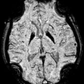 Axial SWI in the same patient shows blooming of hypointense signal within the globi pallidi. The eyes of the tiger are no longer seen, obscured by the blooming effect. SWI is more sensitive than T2* GRE due to magnetic susceptibility effects.