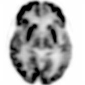 Axial FDG PET of a 55-year-old woman with sv-PPA (clinical subtype of FTD) shows decreased metabolic activity in the left temporal lobe  & to a lesser degree in the right temporal lobe . Note relative sparing of parietal & occipital lobes .