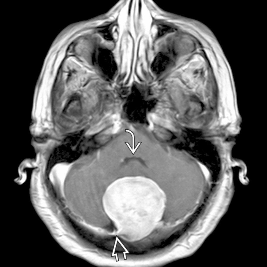 Axial T1 C+ MR of a meningioma shows an avidly enhancing, dural-based mass splaying the cerebellar hemispheres, flattening the 4th ventricle , with dural tail .