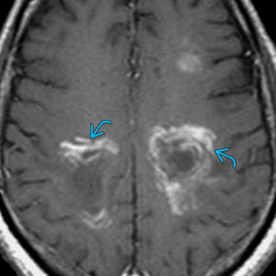 Axial T1 C+ MR demonstrates concentric laminated "onion bulb" enhancement , characteristic of acute Baló concentric sclerosis. Baló concentric sclerosis is a rare aggressive MS variant characterized by acute onset and rapid deterioration.