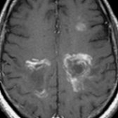Axial T1 C+ MR demonstrates concentric laminated "onion bulb" enhancement , characteristic of acute Baló concentric sclerosis. Baló concentric sclerosis is a rare aggressive MS variant characterized by acute onset and rapid deterioration.