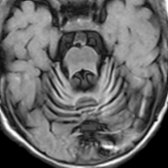 Axial FLAIR MR in a 20-month-old boy with PLAN (INAD) shows progressive cerebellar atrophy with increased cortical signal . This can also be seen in CDG1A, NCL, GM2 gangliosidosis, etc. Abnormal iron is seen in 50% PLAN patients only (not in this case).