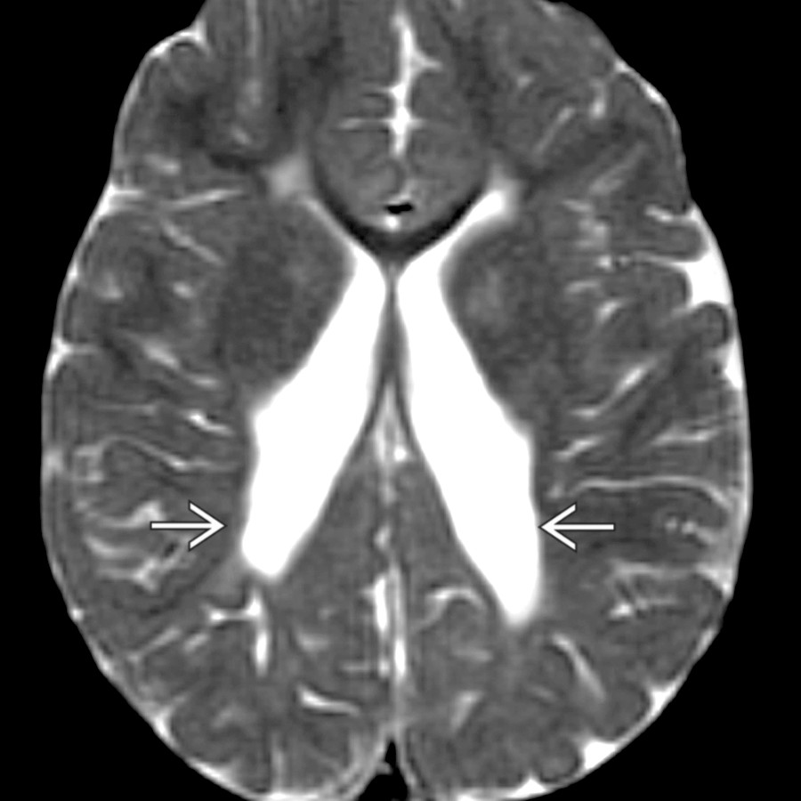Axial T2 MR shows classic "wavy" or undulating contours of the lateral ventricles  in addition to colpocephaly (enlargement of the posterior portions of lateral ventricles). Colpocephaly reflects the predominantly posterior volume loss.