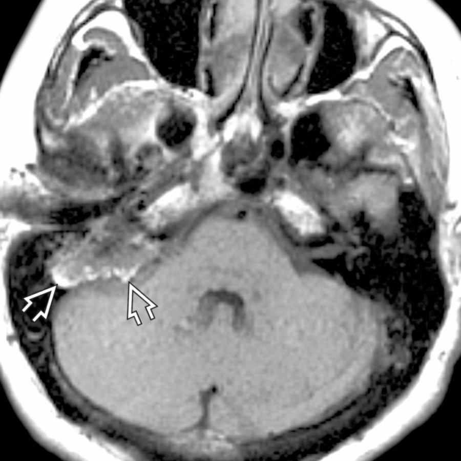 Axial T1WI MR reveals a tumor along the posterior wall of the T-bone with high-signal foci  that is highly suggestive of an endolymphatic sac tumor.