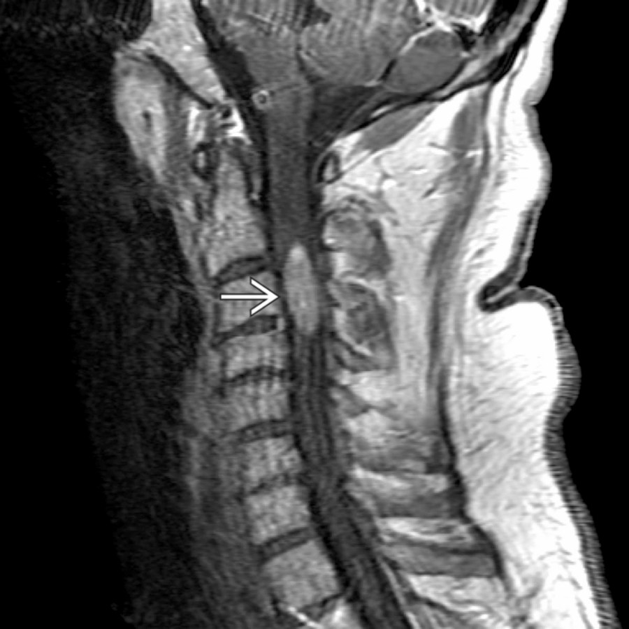 Sagittal T1 C+ MR shows a focal mass enhancing within the cervical cord in this patient with cord metastases .