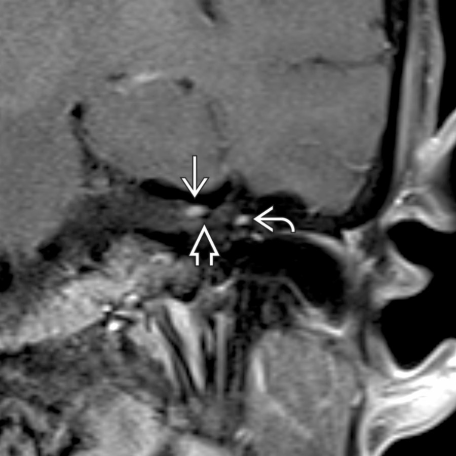 Coronal T1 C+ FS MR in a patient with Bell palsy shows a classic "tuft" of enhancement  at the fundus of the internal auditory canal above the crista falciformis . Note additional enhancement of the tympanic segment  of facial nerve, which courses below the lateral semicircular canal.