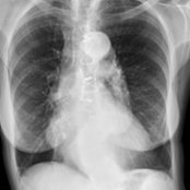 Frontal radiograph shows a dilated tortuous aorta with diffuse calcifications. Intimal disease further exacerbates medial degeneration by increasing wall stress and restricting blood flow.