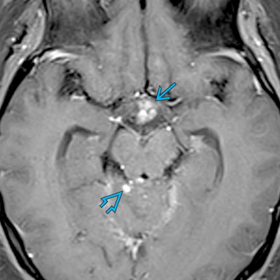 Axial T1 C+ FS MR shows an enhancing suprasellar mass  with additional enhancement in the subarachnoid spaces along the superior cerebellum  related to neurosarcoid. Neurosarcoid often mimics lymphoma and other granulomatous processes.