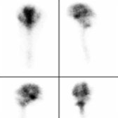 Four-hour multiplanar images in a patient with NPH show normal uptake in the basal, sylvian, and suprasellar cisterns as well as in the lateral ventricles .