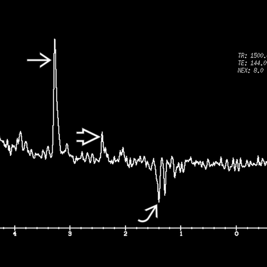 MRS at TR 1500, TE 144 within the cyst cavity of a colloidal vesicular NCC lesion in a patient (not shown) shows peaks of Cho  (3.2 ppm), succinate  (2.4 ppm), and lactate  (1.3 ppm).