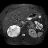 Axial T2 FS MR in a 54-year-old woman with left flank pain shows a 7-cm, complex cystic right adrenal mass with a low-signal hemosiderin ring . A pseudocyst was resected. Signal intensity of pseudocysts varies depending on the age of hemorrhage.