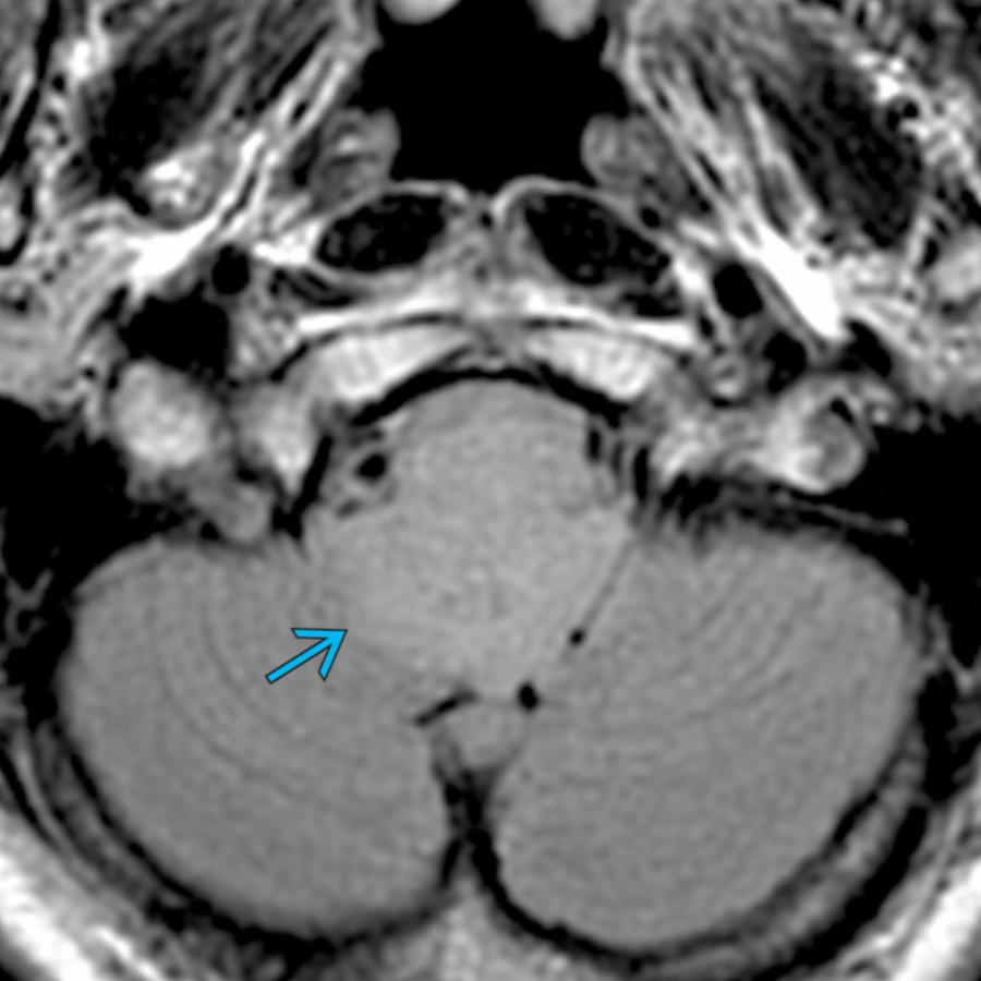 Axial FLAIR MR in a 62-year-old man with a headache shows a hyperintense mass filling the 4th ventricle . Note the lack of edema in the surrounding brain. Subependymomas are most commonly found in the inferior 4th ventricle (50-60%). The lateral ventricle is the next most common location (30-40%). Surgical resection is typically curative.
