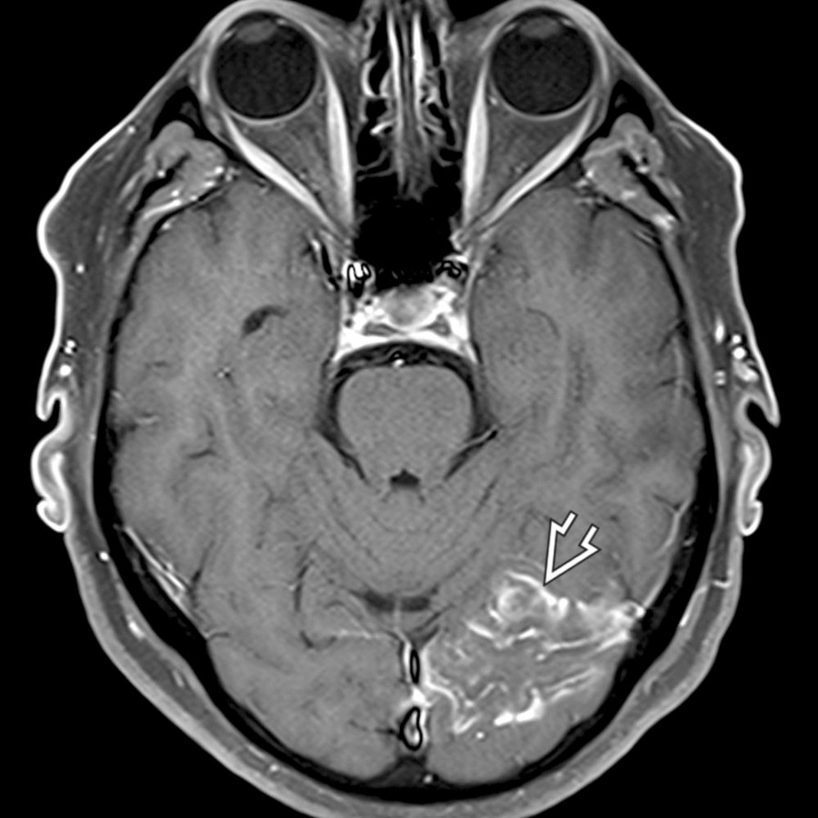 Axial T1 C+ MR in the same patient shows gyriform enhancement along the cortex of the occipital lobe . This enhancement may be seen as early as 2 days and may last up to 2 months after the patient's initial ischemic event. Without clinical history, imaging may mimic a tumor, venous infarct, or cerebritis.