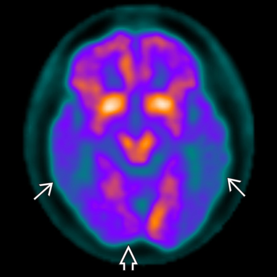 Axial FDG PET in a patient with Lewy body disease shows parietal and posterior temporal reduction similar to Alzheimer disease (AD) , but occipital cortex  is also involved.