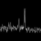 MRS at a long TE in the same patient shows the tumefactive lesion has a depressed choline  and NAA  metabolites in the presence of a large lactate doublet . This MRS helps distinguish this lesion from a neoplasm. MRS of ADEM may show elevated choline acutely.