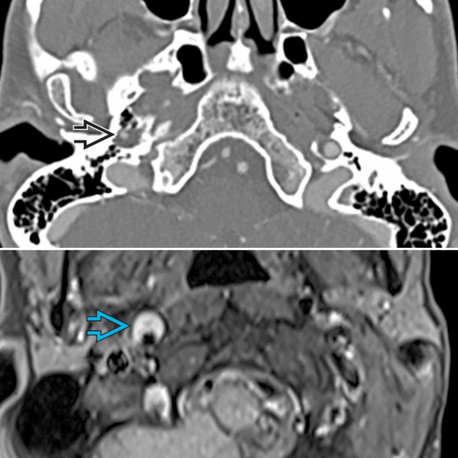 CTA shows traumatic dissection of the ICA with narrowing  and associated intramural hematoma on MR . Intramural hematoma can be detected on MR using T1 FS MR or MPRAGE. Methemoglobin within intramural hematoma is T1 hyperintense.
