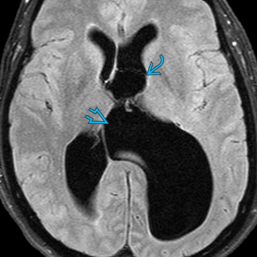 Axial FLAIR MR in a patient with IVOH shows an ependymal cyst  at the foramen of Monro with asymmetric dilatation of the lateral ventricles, L > R. There is marked bulging of the medial wall  of the left lateral ventricle.