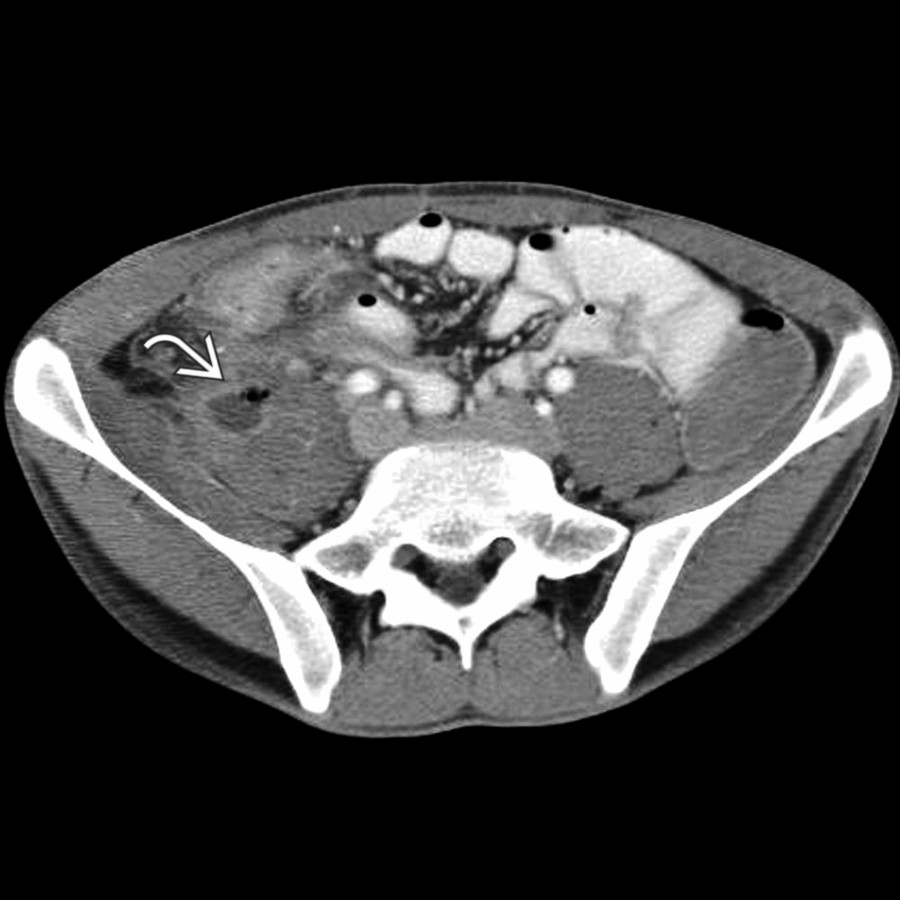 Axial CECT shows a small collection of gas and fluid  within the psoas muscle due to Crohn disease with a sinus tract from the terminal ileum.