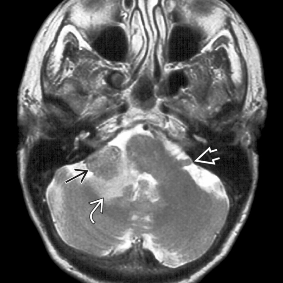 Axial T2 MR in a female patient with breast carcinoma shows a lobulated extraaxial mass in the right flocculus  with associated parenchymal edema . Note the normal flocculus on the left .