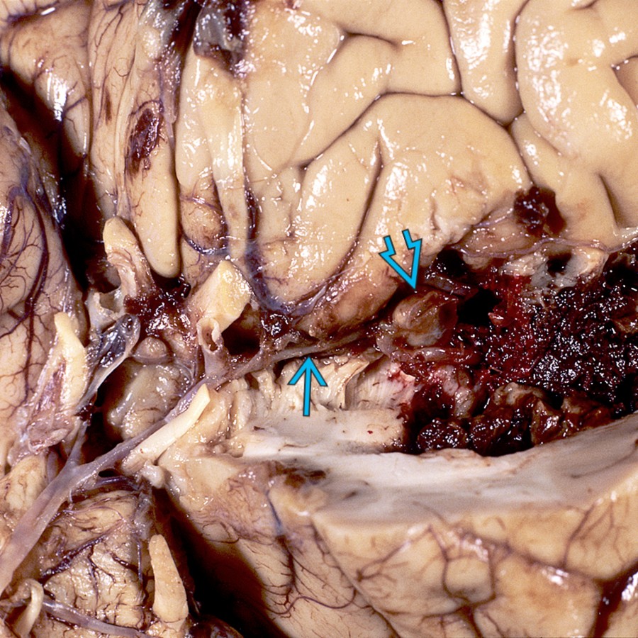 Autopsied case of ruptured MCA aneurysm  with subarachnoid hemorrhage (SAH) in a patient who survived several days shows severe vasospasm of the parent MCA .