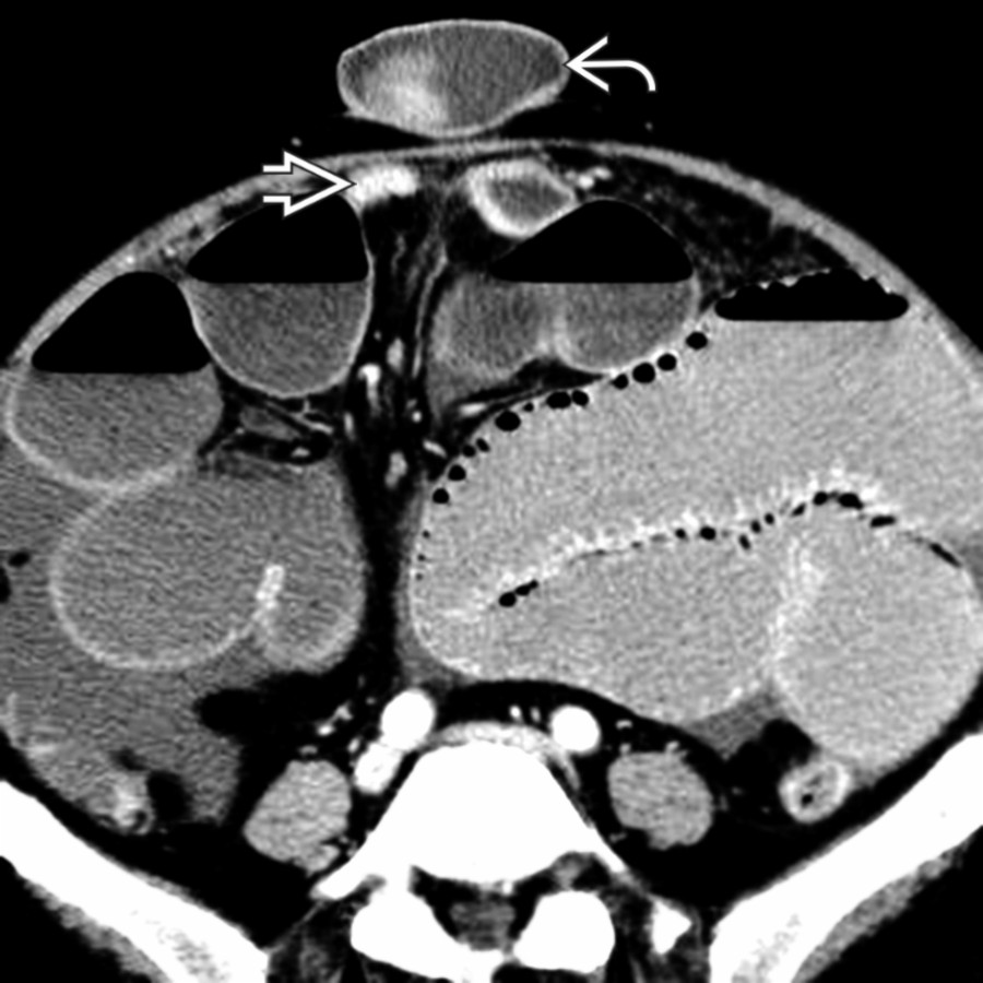 Axial CECT in the same patient again demonstrates the umbilical hernia . Note the collapsed loop of small bowel  leaving the hernia sac, confirming the hernia as the cause of the small bowel obstruction. Umbilical hernias are common among patients with cirrhosis and ascites due to thin abdominal wall musculature and chronically increased intraabdominal pressure.