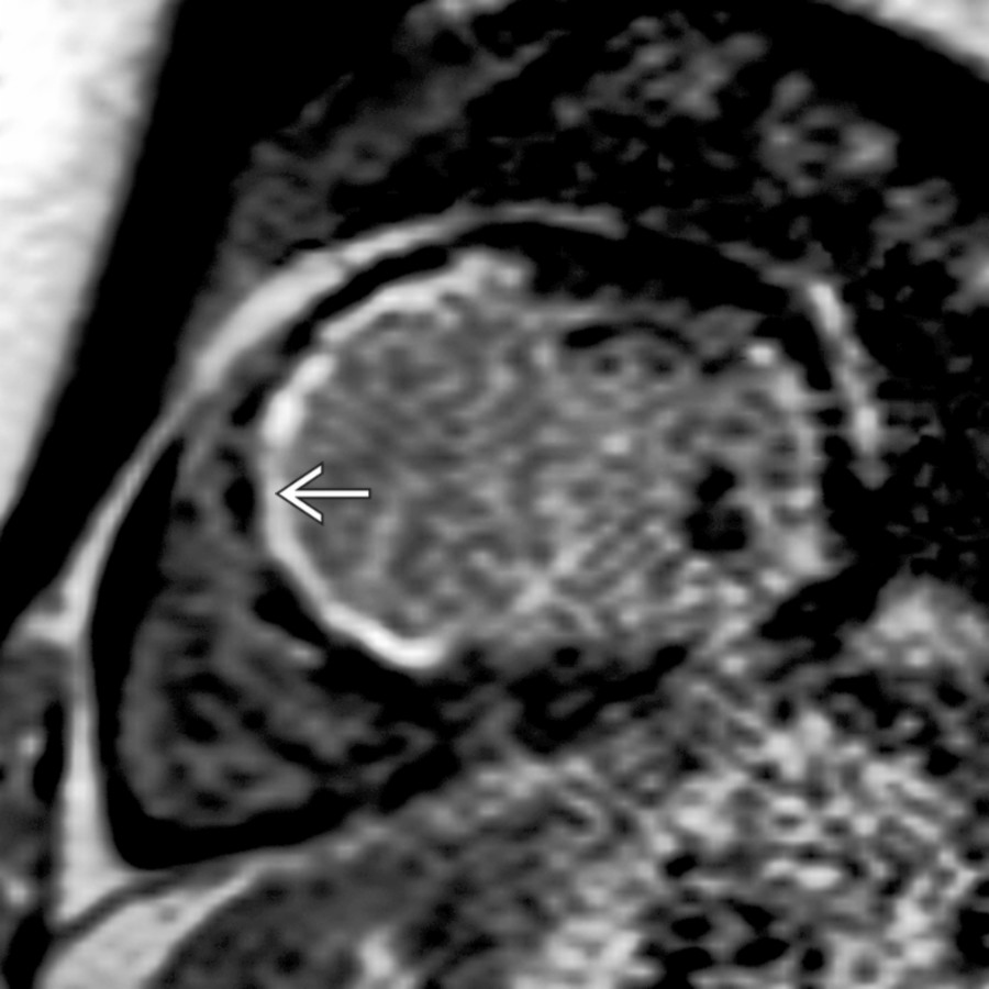 Short-axis delayed contrast-enhanced image shows subendocardial enhancement  in the septal and anterior wall at the base. The patient had hypokinesis and wall thinning at this location.