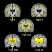 Coronal graphic depicts cerebrospinal fluid (CSF) movement patterns: Type I: Normal clearance of ventricles at 2-6 hours with tracer along the convexities at 24 hours; type II: Normal clearance of ventricles with delayed tracer along the convexities seen in aging; type IIIA: Early transient ventricular tracer with delayed tracer along the ventricles, indeterminate for normal-pressure hydrocephalus (NPH); type IIIB: Early transient ventricular tracer without convexity circulation, suggesting NPH; and type IV: Persistent ventricular tracer at 24 hours without convexity circulation, suggesting NPH.