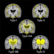 Coronal graphic depicts cerebrospinal fluid (CSF) movement patterns: Type I: Normal clearance of ventricles at 2-6 hours with tracer along the convexities at 24 hours; type II: Normal clearance of ventricles with delayed tracer along the convexities seen in aging; type IIIA: Early transient ventricular tracer with delayed tracer along the ventricles, indeterminate for normal-pressure hydrocephalus (NPH); type IIIB: Early transient ventricular tracer without convexity circulation, suggesting NPH; and type IV: Persistent ventricular tracer at 24 hours without convexity circulation, suggesting NPH.