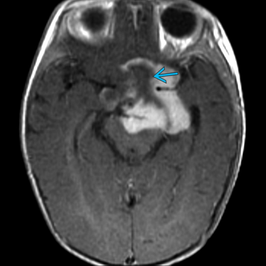 Axial T1 C+ MR shows the enhancing mass in the suprasellar cistern has a central nonenhancing structure consistent with an enlarged optic chiasm . This tumor was a pilocytic astrocytoma at biopsy.