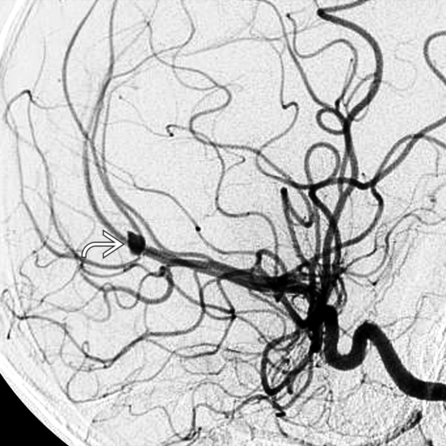 Lateral catheter DSA in an infant with AHT shows a posttraumatic pseudoaneurysm at the junction of the pericallosal & callosal-marginal arteries .