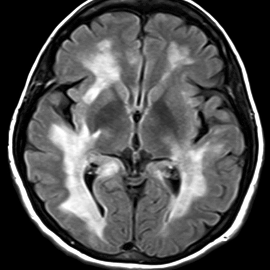 Axial FLAIR MR shows confluent periventricular white matter hyperintensity typical of advanced, longstanding MS with loss of discrete, linear, periventricular lesions.