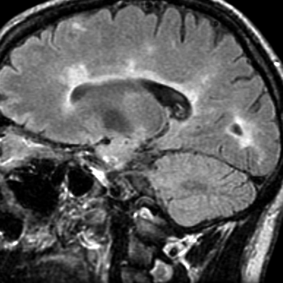 Sagittal FLAIR MR shows callososeptal hyperintensities radiating from the lateral ventricles with a typical perpendicular orientation, characteristic of MS.
