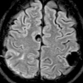 Axial FLAIR MR shows cystic lesions  in the right frontal and left parietal lobes. An eccentric nodule (scolex)    seen in the right frontal lesion on this image helps make the diagnosis of neurocysticercosis.