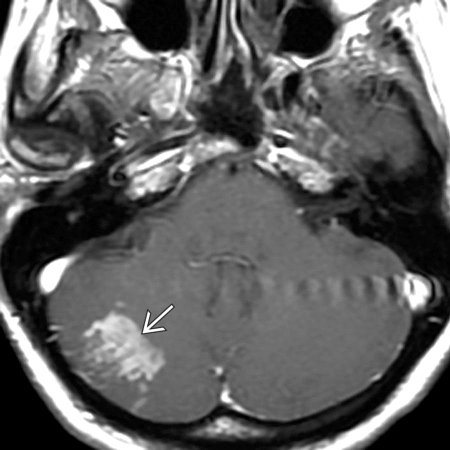 Axial T1 C+ MR in the same patient shows patchy enhancement in the right cerebellar hemisphere . Cardioembolic disease represents 15-25% of major strokes.