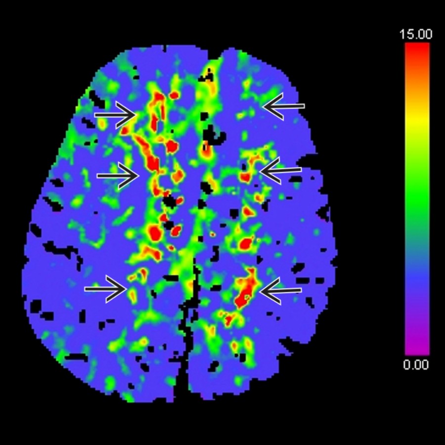 Axial mean transit time (MTT) CT perfusion map generated using DC shows abnormal increased MTT in the same regions . Cerebral blood flow (CBF) was also reduced in these regions (not shown). As seen here, TTD has higher sensitivity to demonstrate ischemia than other color parametric maps.